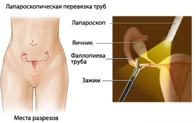 Стерилизация женщины, схема