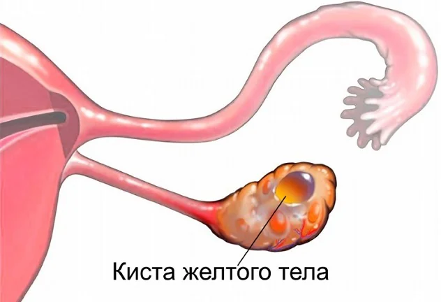 причиной боли в яичниках на ранних сроках беременности может быть киста желтого тела