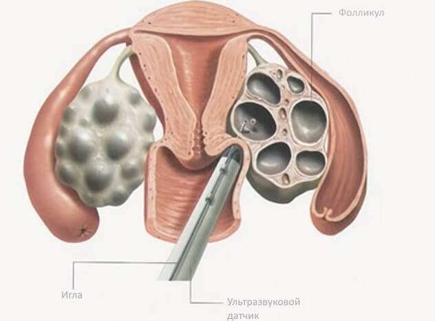 Пункция фолликулов перед ЭКО: схема