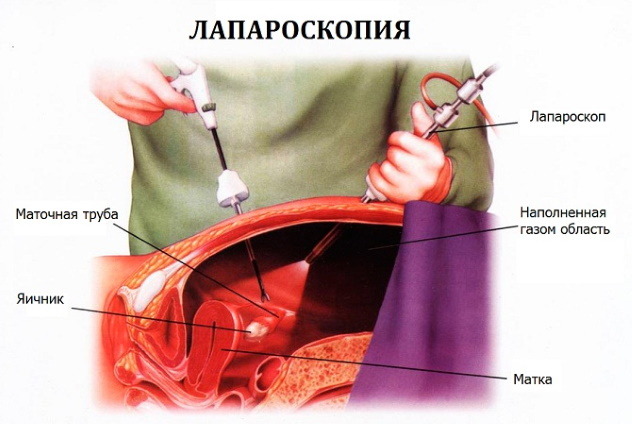 УЗИ можно заменить тестом ХГЧ и лапароскопией