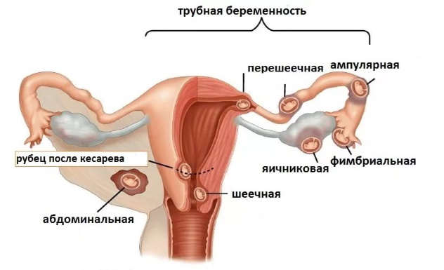 локализация внематочной беременности