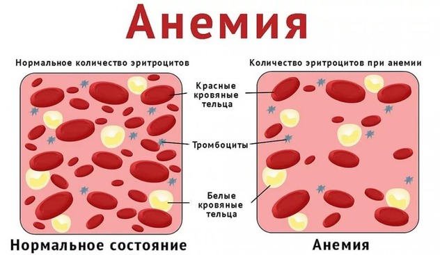 Низкий гемоглобин при беременности диагностируется у 40% женщин