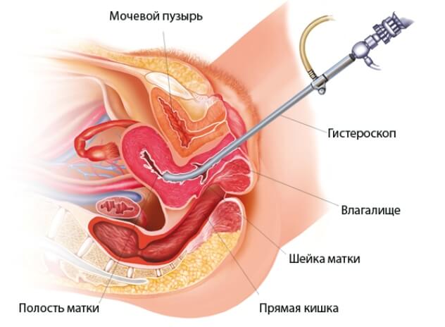 Гистероскопия перед ЭКО: схема