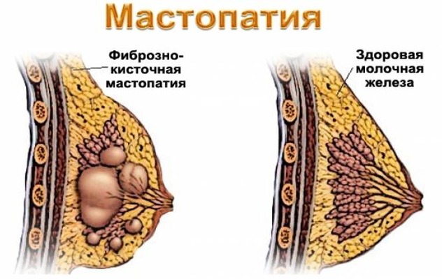 Мастопатия не мешает беременности, но за патологией нужно следить