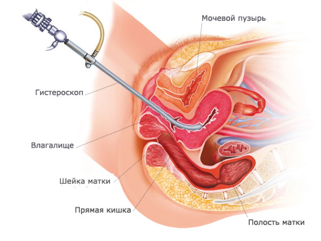 удаление полипа в матке