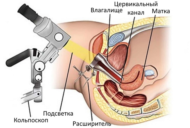 кольпоскопия при полипах и беременности 