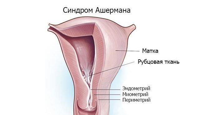 синдром ашермана после удаления полипа