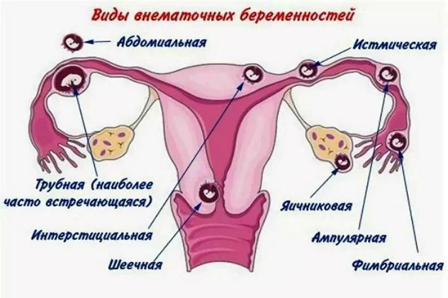 покалывание в животе при беременности в отрместре может быть симптомом внематочной беременности