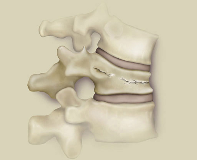 Компрессионный перелом позвоночника