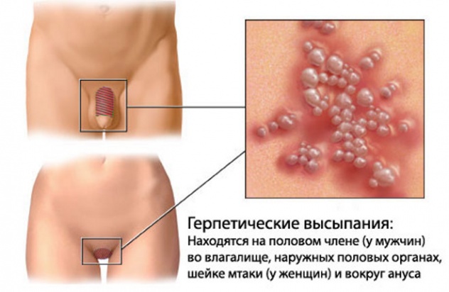 сыпь при генитальном герпесе