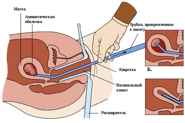 процедура хирургического аборта