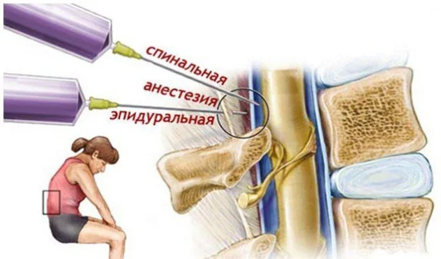 глубина инъекции при спинальной и эпидуральной анестезии