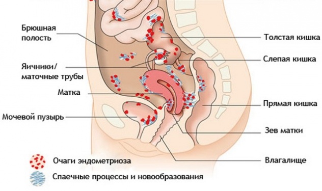 спаечный процесс при эндометриозе