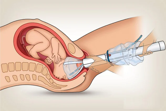 применение вакуума при родах