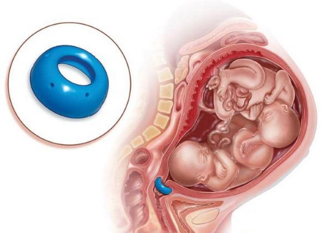 Пессарий при укорочении длины шейки матки при беременности
