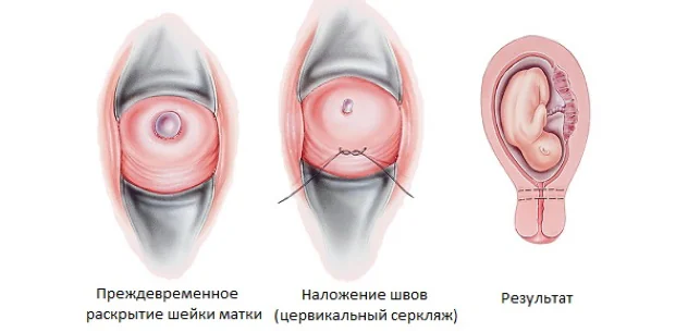 Серкляж при укорочении длины шейки матки при беременности