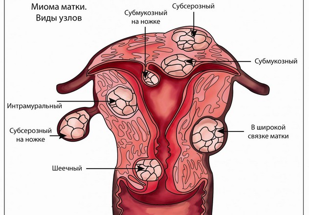 виды миомы