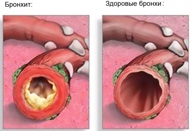 последствия бронхита