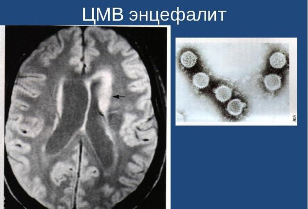 энцефалит - последствие цмв у нововрожденного