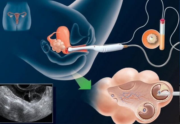 Пункция яичников