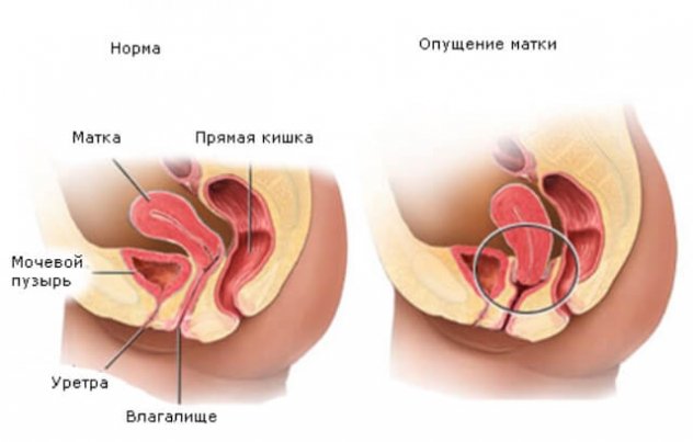 Опущение шейки матки после родов