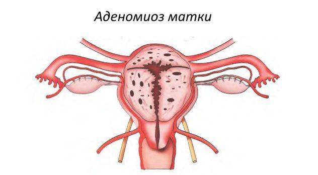 Аденомиоз и беременность