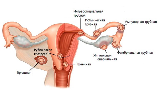 Типы внематочной беременности