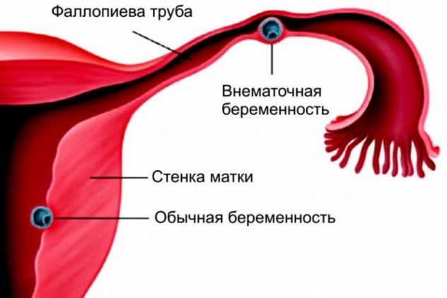 Лечение внематочной беременности