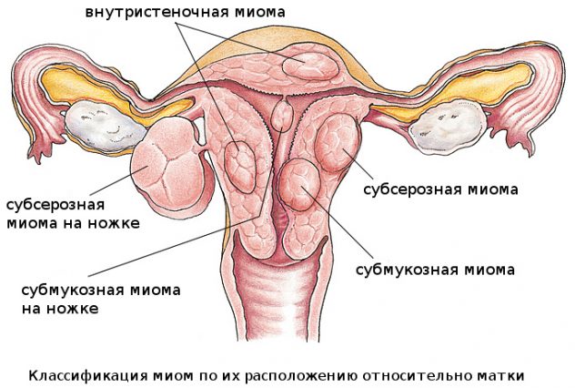 Лечение миомы матки