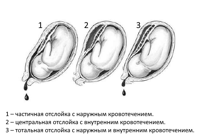 степени отслойки плаценты и кровотечения