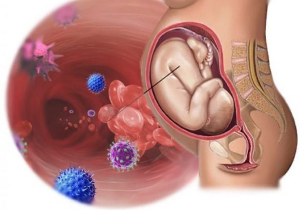 санация влагалища при беременности предотвращает инфицирование плода