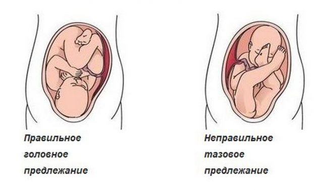 Коленно-локтевая позиция особенно актуальна при неправильном предлежании плода