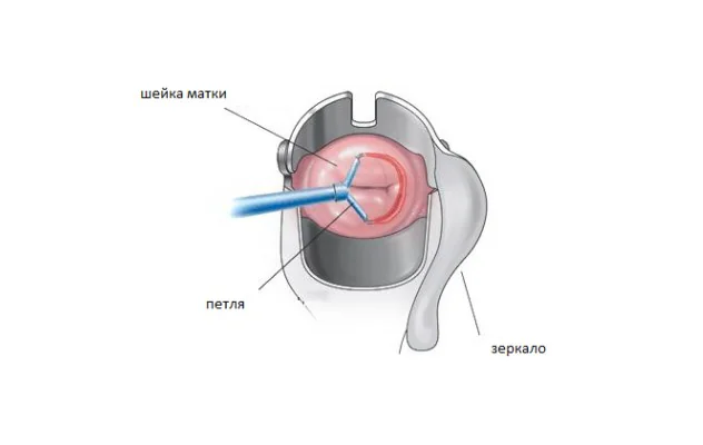 Петлевой метод конизации шейки матки