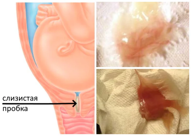 кровянистые выделения при беременности - выход слизистой пробки