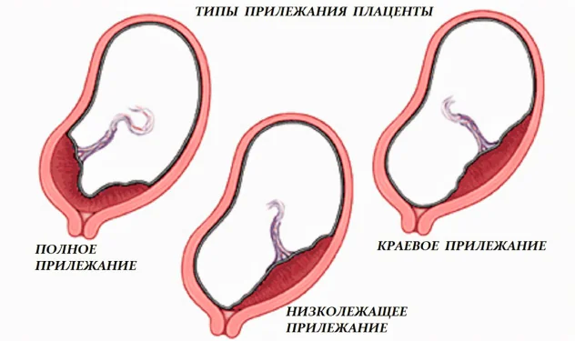 причина кровотечения при беременности – предлежание плаценты