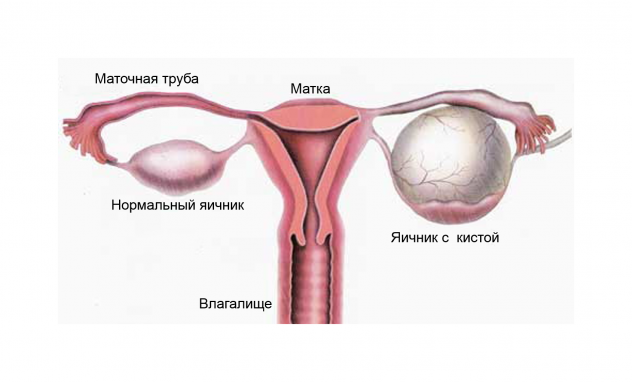 Лечение кисты яичника