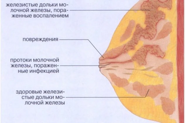 боль в груди при грудном вскармливании может быть симптомом мастита