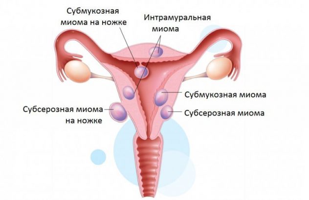 миомы матки - показание для искусственного климакса