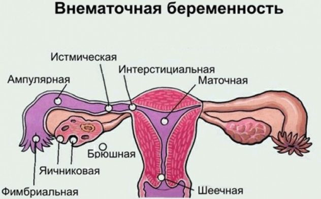 Внематочная беременность - одна из причин тянущих болей внизу живота