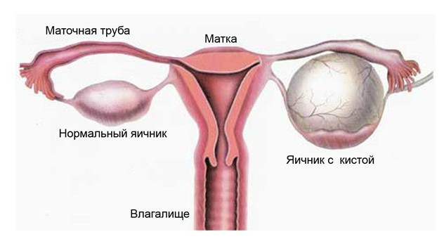 Можно ли забеременеть при кисте яичника