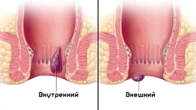 геморрой при беременности