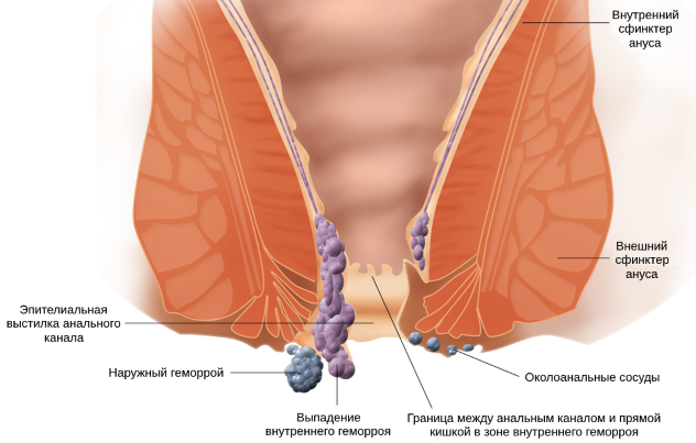 наружный геморрой при беременности