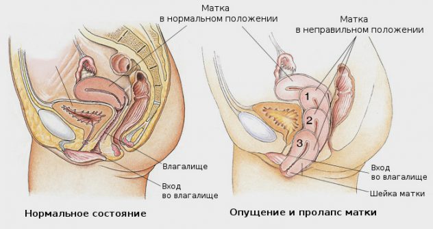 Лечение опущения влагалища