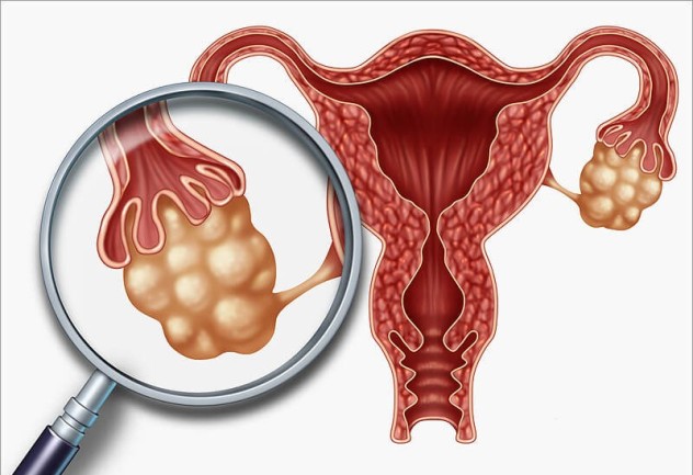 как лечат поликистоз яичников
