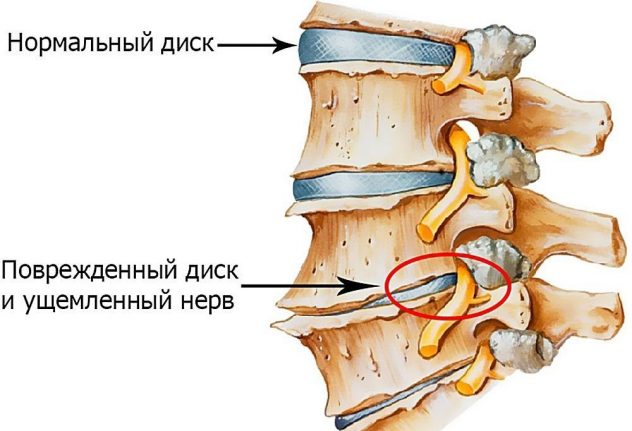 ущемление нервных окончаний в спине после родов