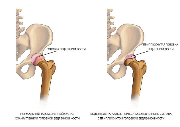 болезнь пертеса 