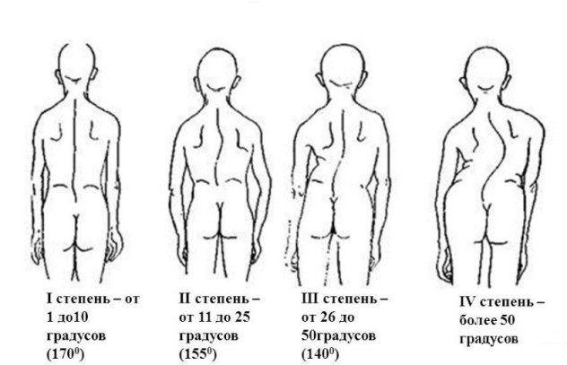 степени сколиоза у детей