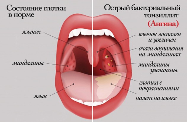  ангина у ребенка