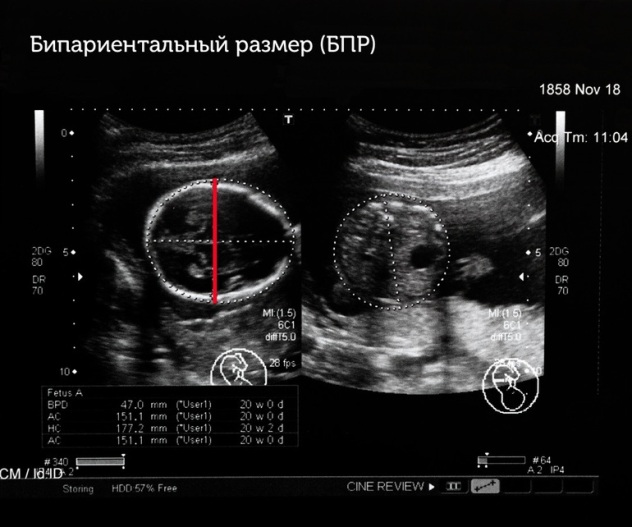 Бипариетальный размер головки плода