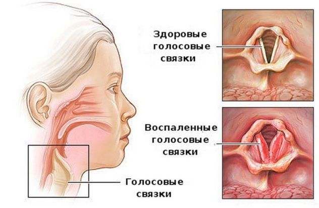 Ларинготрахеит у ребенка